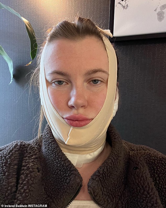 Uzdrowienie: W nowym filmie na Instagramie opublikowanym we wtorek po południu 26-letnia modelka wyjaśniła, że ​​FaceTite to minimalnie inwazyjna, godzinna procedura w gabinecie, która nawet nie wymaga znieczulenia.