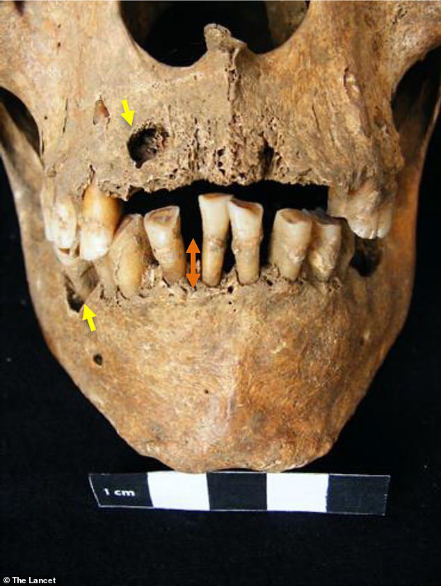 Chociaż archeolodzy nie wiedzieli, że szczątki były podziurawione chorobą, na czaszce widoczne są ślady, takie jak większe niż przeciętne zęby i poważna infekcja dziąseł, która przed śmiercią uszkodziła tkanki miękkie w jamie ustnej.